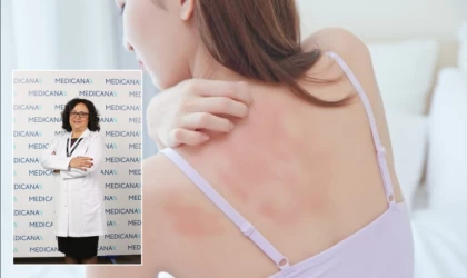 Ürtiker günlük yaşamı zindan ediyor