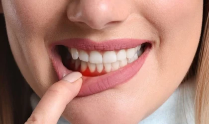 Çapraşık Dişler, Diş Eti Hastalıklarına Neden Olabilir